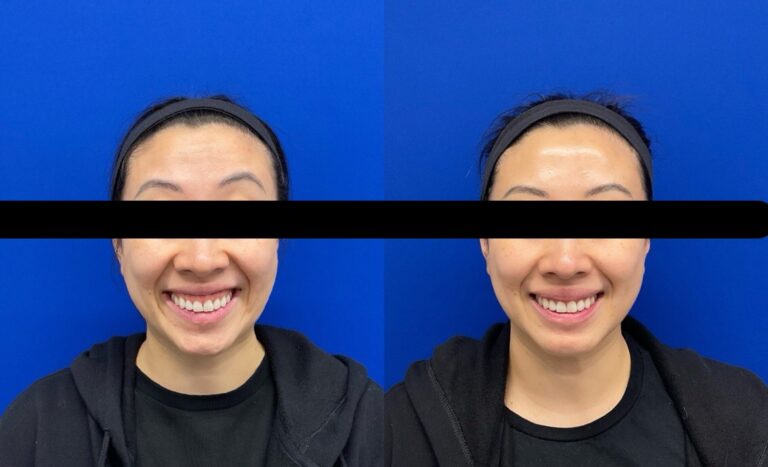 Pt. BX Botox for gummy smile 50