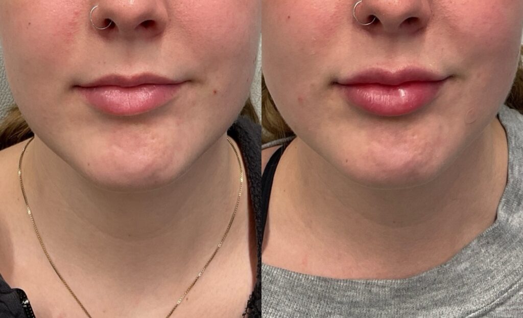 Pt. DG lip filler 55