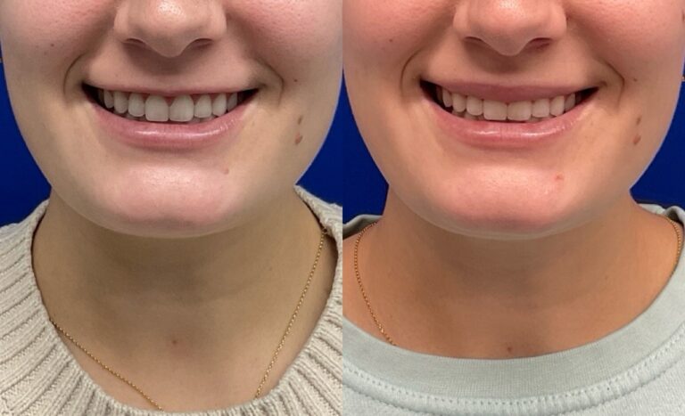 Pt. EHM Botox Lip Flip 51