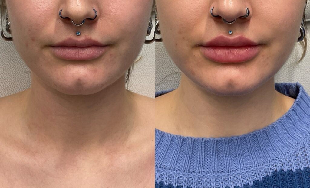 Pt. GO lip filler 56