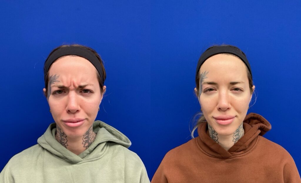 Pt. JD Botox between the brows 52