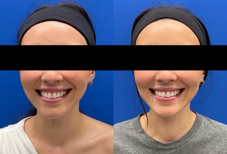 Pt. JS Botox for gummy smile 54