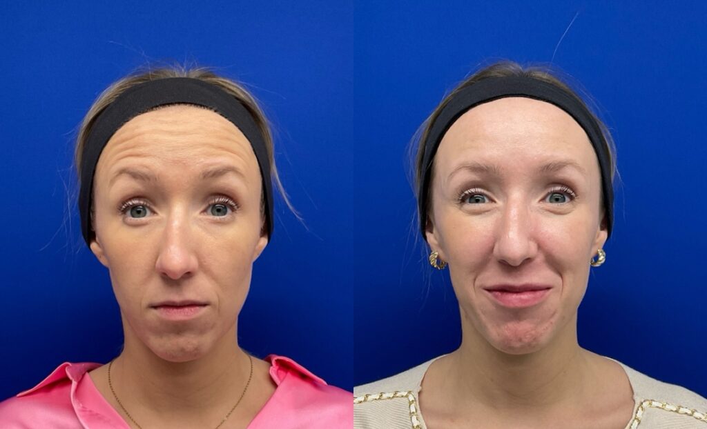 Pt. JW Forehead Botox 55