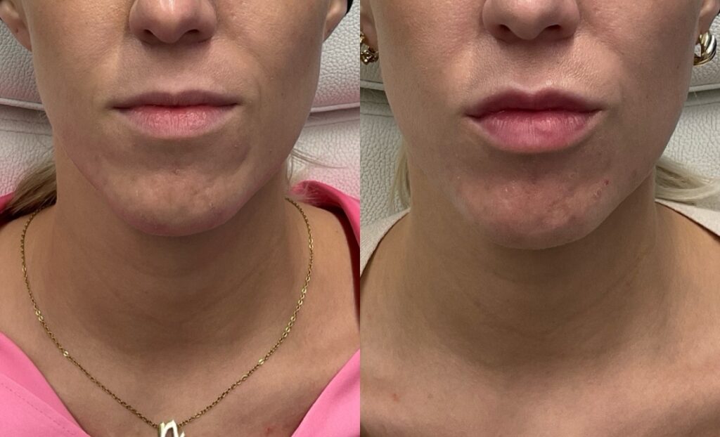 Pt. JW lip filler 57