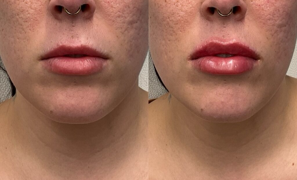 Pt. KV lip filler, immediately post injection (1) 50