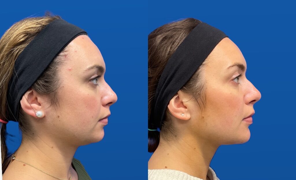 Pt. LL chin filler 50