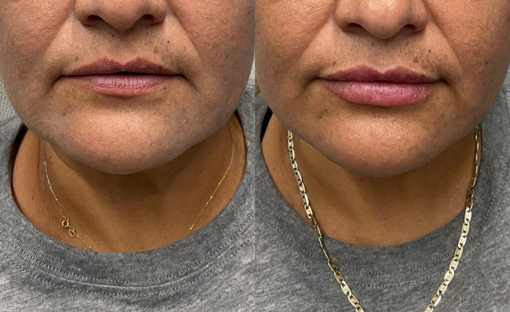 Pt. MC lip filler 59