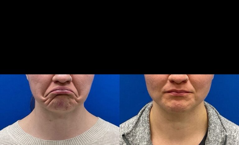 Pt. MP Botox for lower face 56