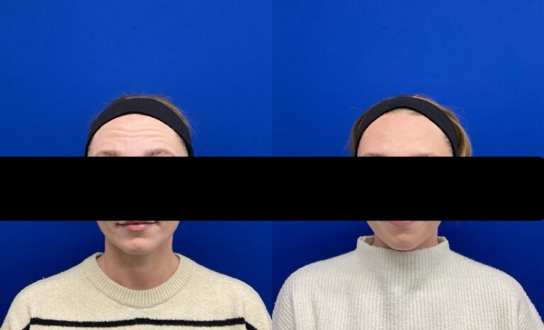 Pt. NM Botox for forehead 57