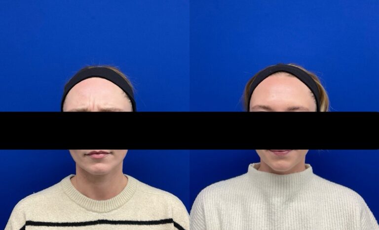 Pt. NM Botox for frown lines between the brows 58