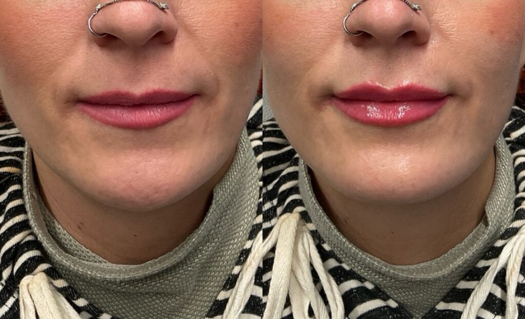 Pt. NS lip filler 59