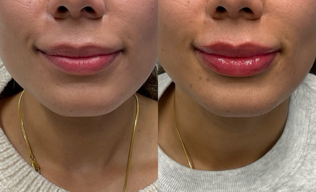 Pt. SB lip filler 62