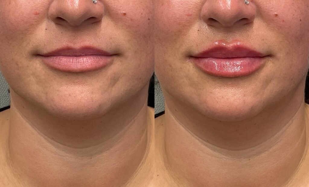Pt. SB lip filler immediately post injection 61