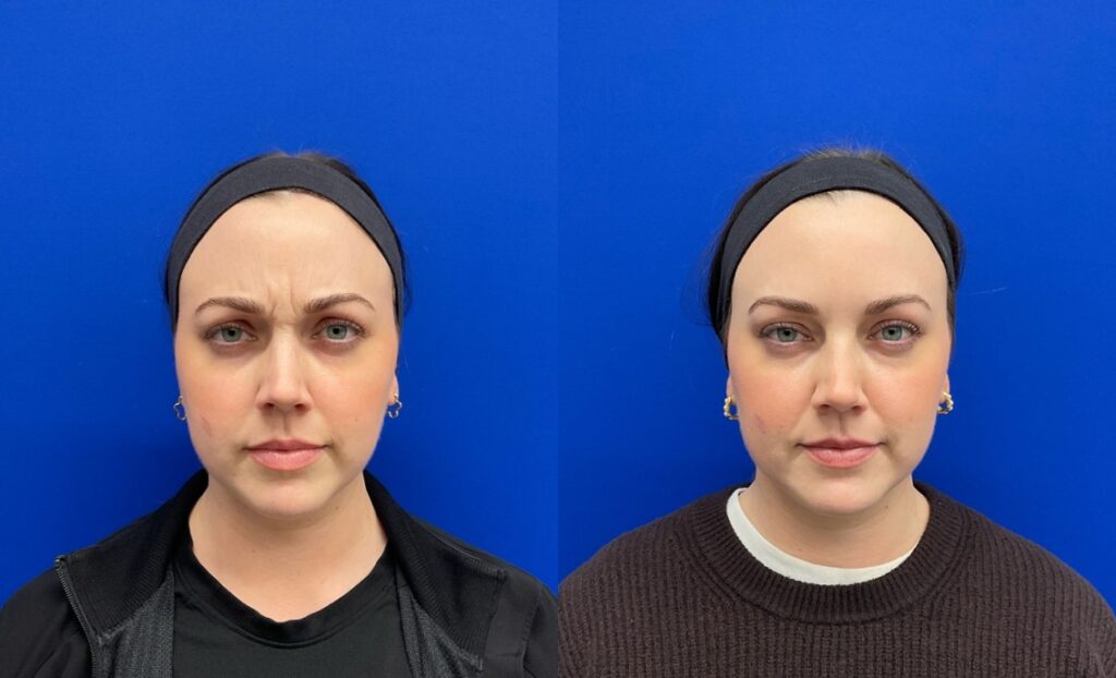 Pt. SL Botox between the brows 60