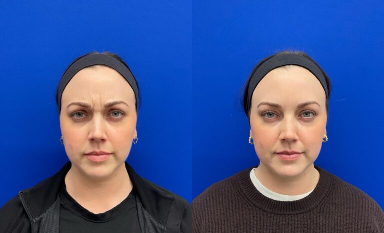 Pt. SL Botox between the brows 60