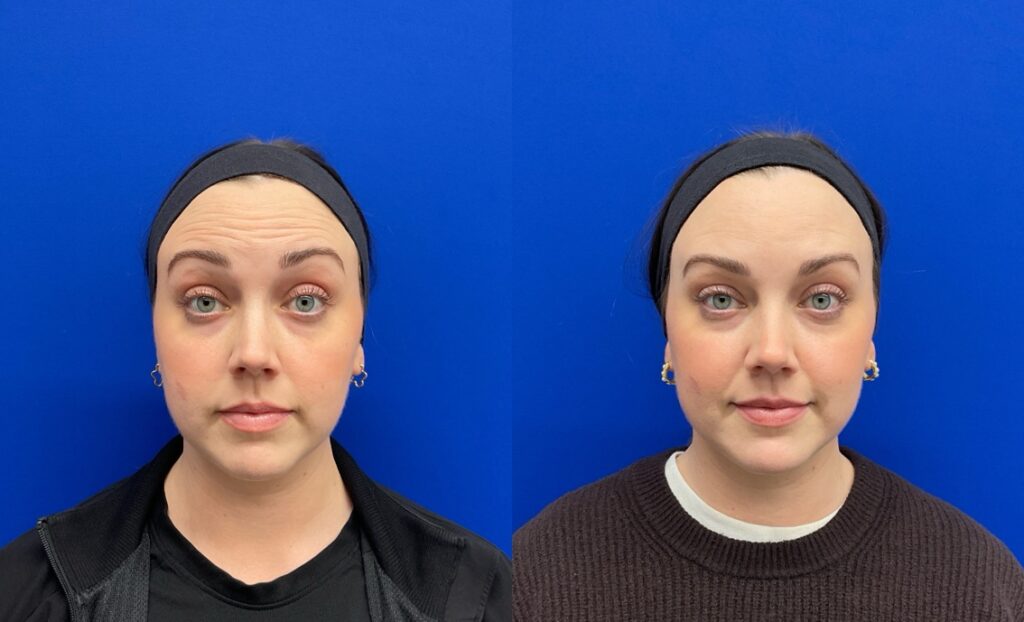 Pt. SL Botox forehead61