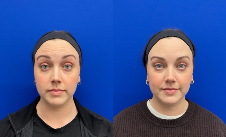 Pt. SL Botox forehead61