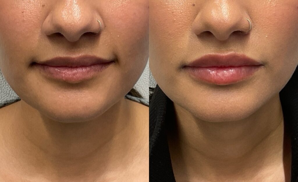 Pt. YK lip filler 64