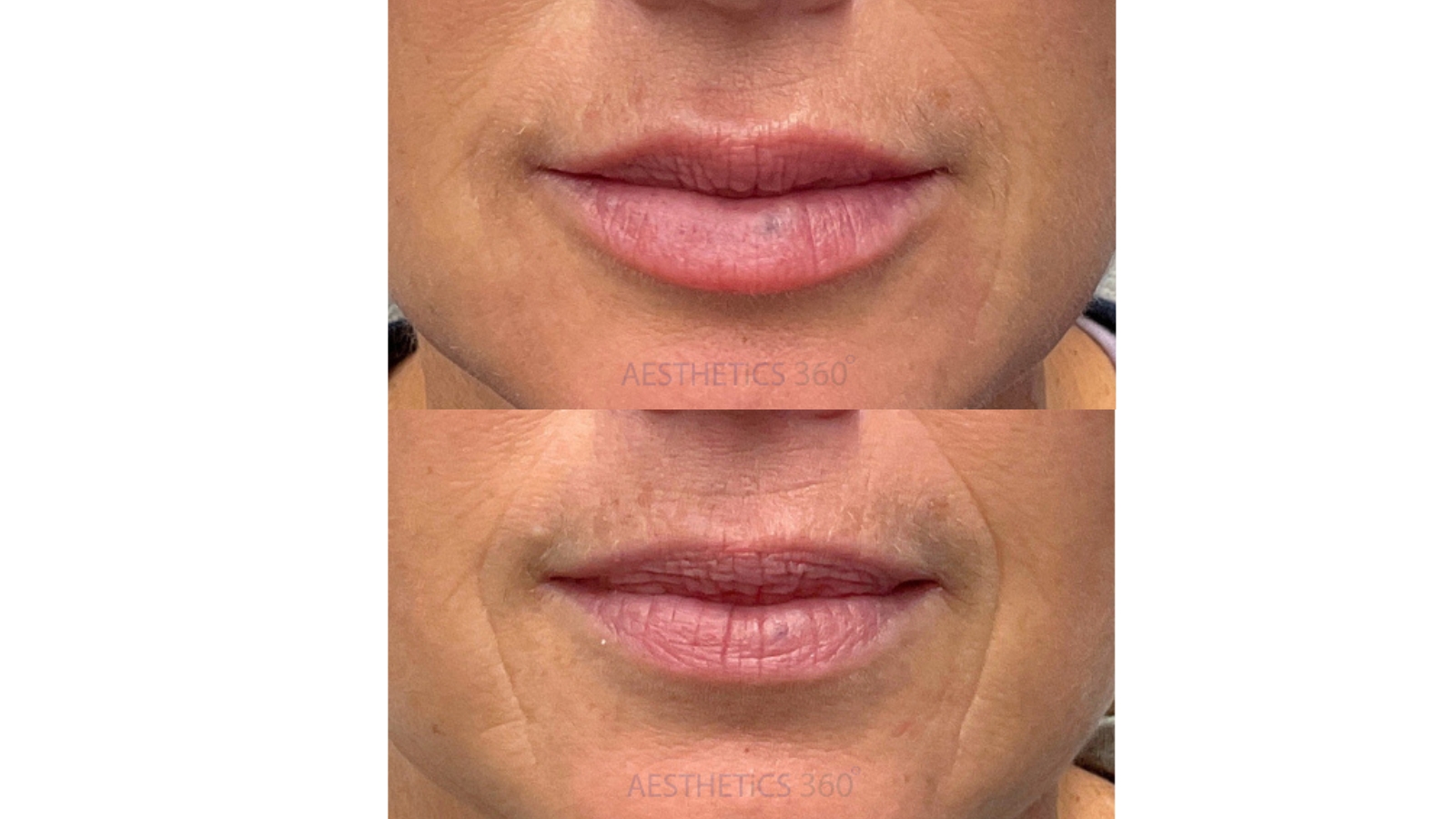 before and after lip fillers