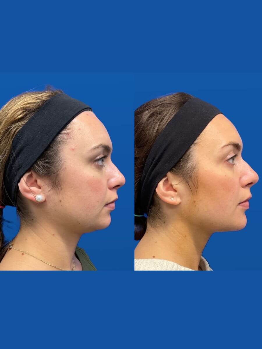 woman after facial balancing procedure
