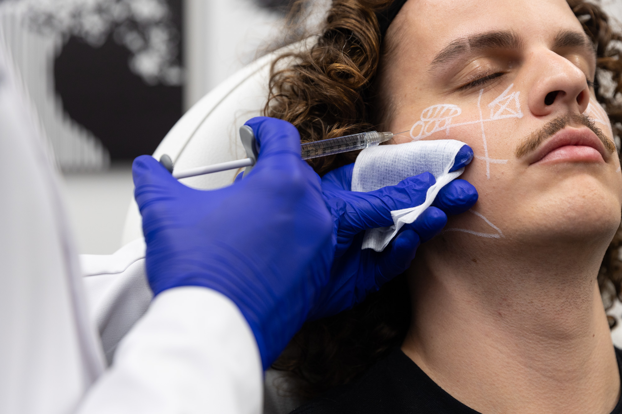 Male in the process of getting cheek filler
