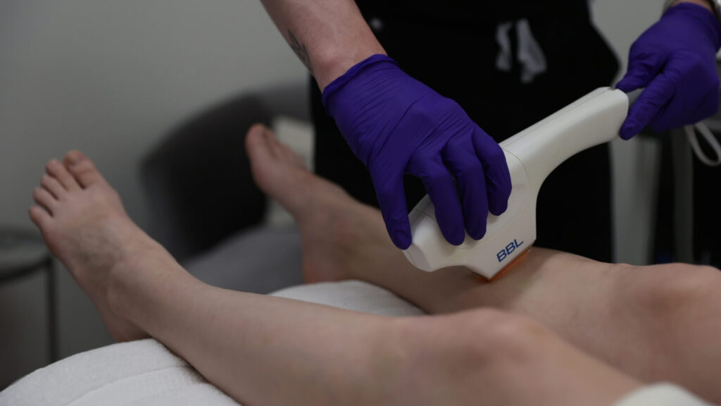 Laser hair removal on a woman's leg
