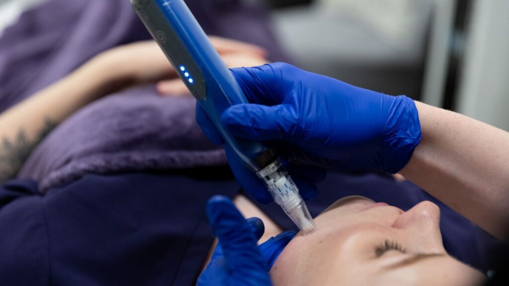 Performing microneedling on a woman's face
