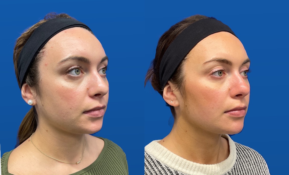 Milwaukee Full Facial Balancing Before and After