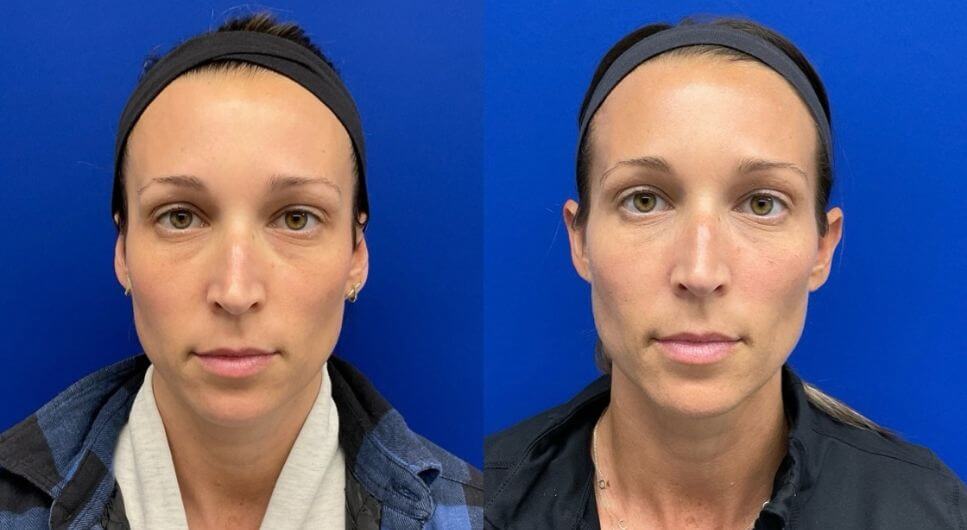 C.T. 7 mos. post 1 vial 4.5 mos. post 2nd vial Sculpta