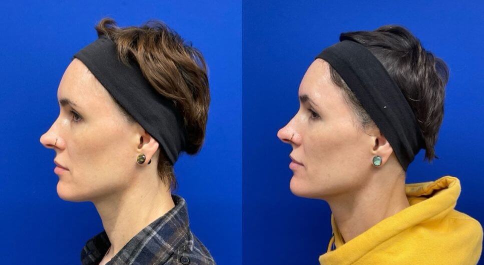 J.F. 4 mos. post 2 vials Sculptra