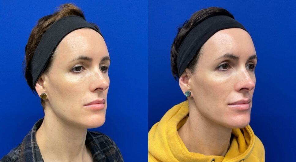 J.F. 4mos. post 2 vials Sculptra
