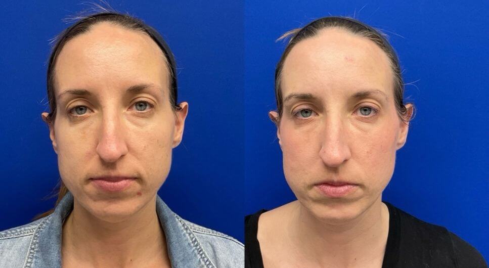 K.D. pre Sculptra 90 days post 4th vial
