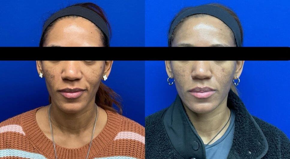 L.R. Sculptra 15 wks post 2nd vial 5 mos. post 1st vial