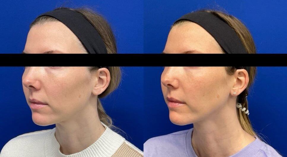 M.H. Sculptra 90 days post 2nd vial