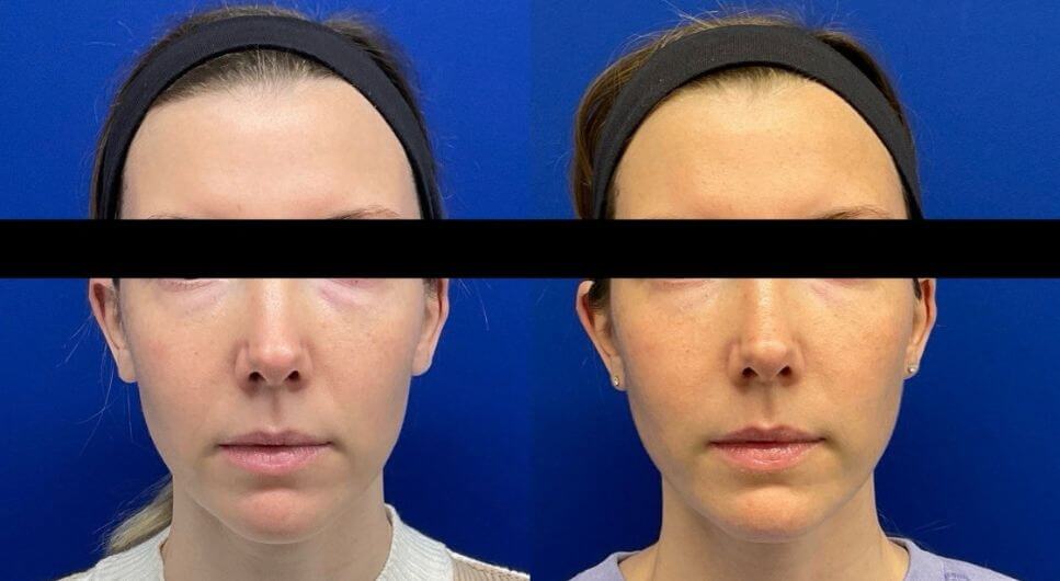 M.H.Sculptra 90 days post 2nd vial