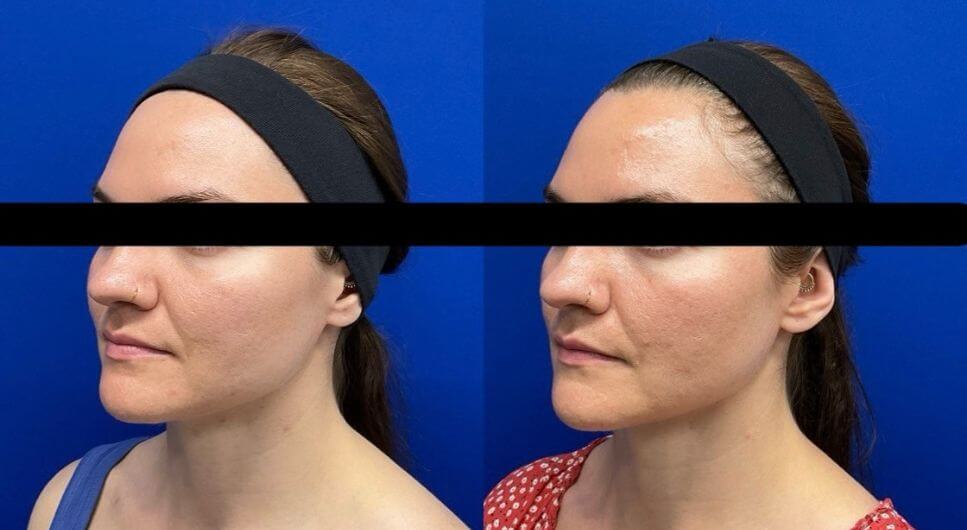 M.P. Sculptra 19 wks post 1 vial 14 wks post 2nd vial-2