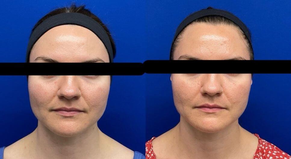 M.P.Sculptra 19 wks post 1 vial 14 wks post 2nd vial