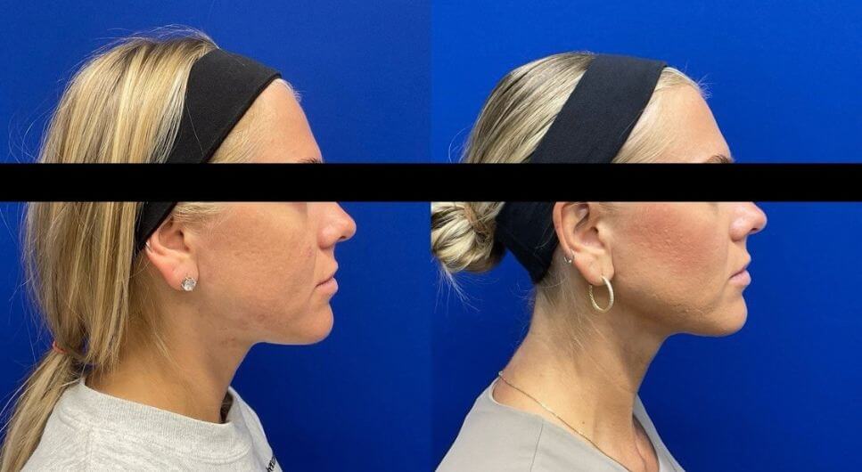 S.P. Sculptra 10 wks post 2 additional vials 14 mos post 4 vials