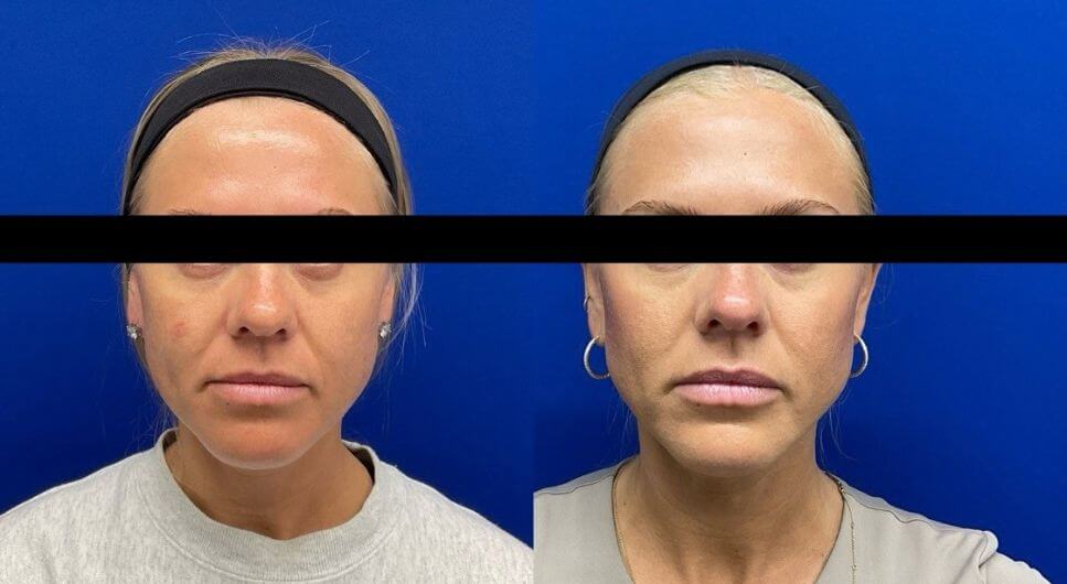 S.P. Sculptra 10 wks post 2 vials 14 mos. post 4 vials