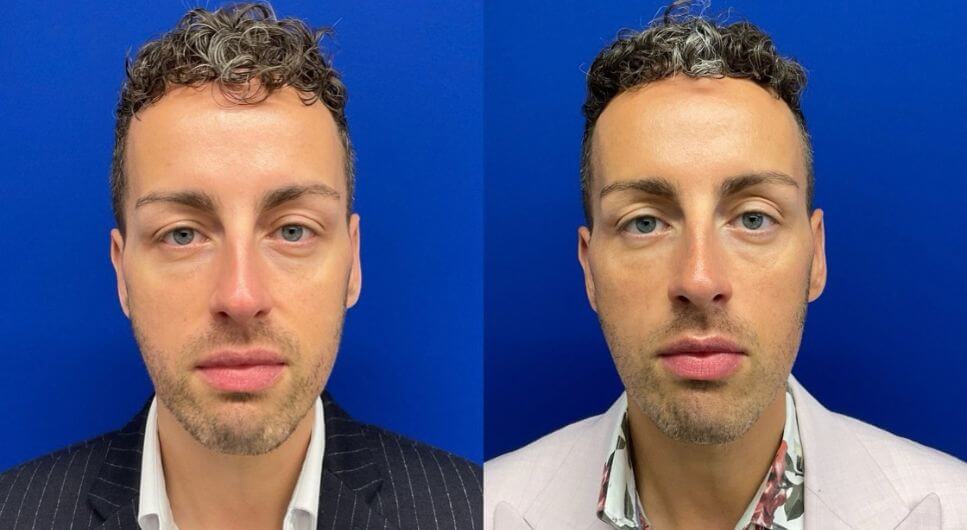 pre-Sculptra 90 days post