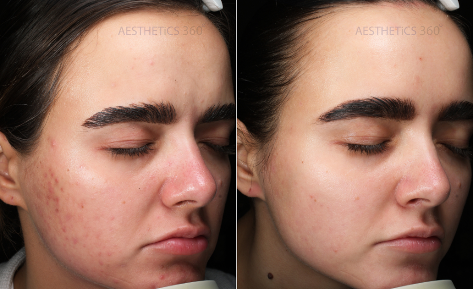 before and after results of a salt facial