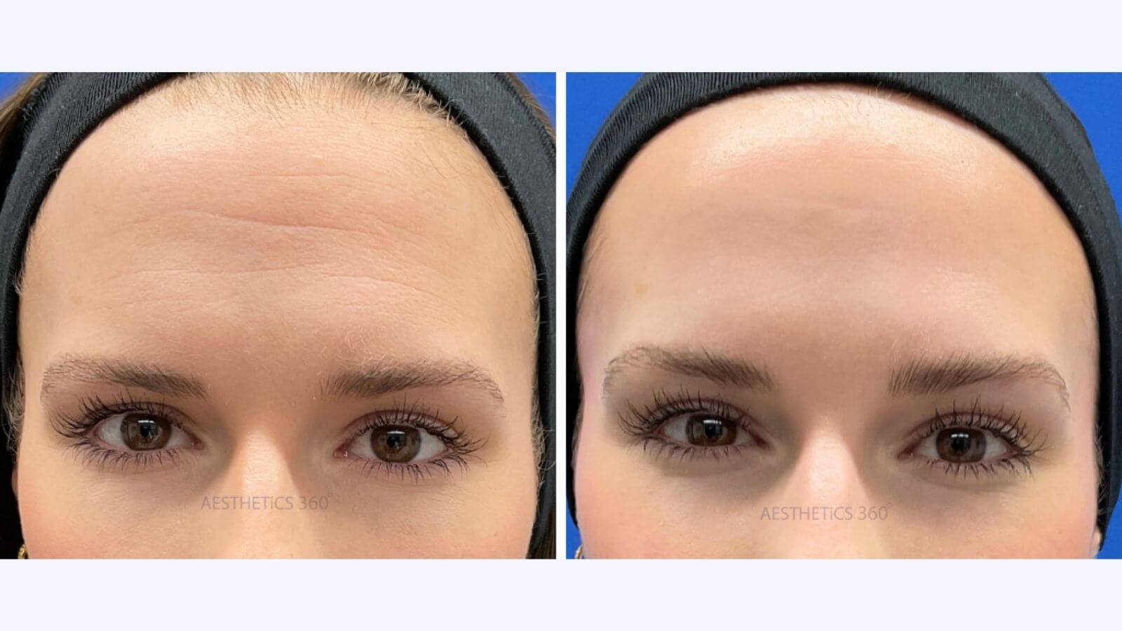 before and after image of a wrinkle relaxer treatment